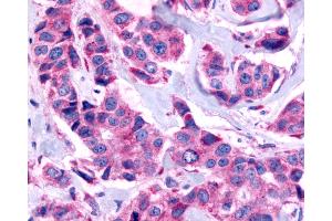 Anti-GPR115 antibody IHC of human Breast, Carcinoma.