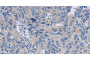 Immunohistochemistry of paraffin-embedded Human ovarian cancer tissue using GRIN1 Polyclonal Antibody at dilution 1:50 (GRIN1/NMDAR1 antibody)