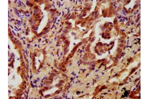 IHC image of ABIN7165707 diluted at 1:700 and staining in paraffin-embedded human lung cancer performed on a Leica BondTM system. (PKC eta antibody  (AA 1-678))
