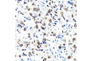 Immunohistochemistry of paraffin-embedded human liver cancer using CRM1/XPO1 antibody (ABIN7267067) at dilution of 1:100 (40x lens). (XPO1 antibody)