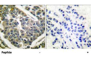 Immunohistochemical analysis of paraffin-embedded human breast carcinoma tissue using COL4A1 polyclonal antibody . (COL4A1 antibody  (AA 31-70))