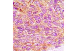 Immunohistochemical analysis of JAK2 (pY1007) staining in human breast cancer formalin fixed paraffin embedded tissue section. (JAK2 antibody  (C-Term, pTyr1007))