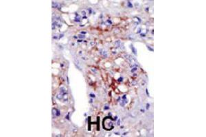 Formalin-fixed and paraffin-embedded human hepatocellular carcinoma tissue reacted with PIP5K1C polyclonal antibody  , which was peroxidase-conjugated to the secondary antibody, followed by AEC staining.