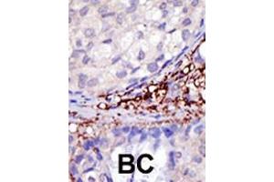Formalin-fixed and paraffin-embedded human cancer tissue reacted with the primary antibody, which was peroxidase-conjugated to the secondary antibody, followed by DAB staining. (RNF216 antibody  (C-Term))