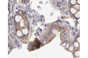 ABIN6267374 at 1/200 staining human colon cancer tissue sections by IHC-P. (Src antibody  (pTyr419))