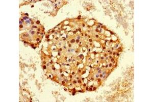 Immunohistochemistry of paraffin-embedded human breast cancer using ABIN7155138 at dilution of 1:100 (HNRNPA2B1 antibody  (AA 1-249))