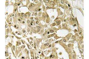 Immunohistochemistry analyzes of Catenin-β antibody in paraffin-embedded human breast carcinoma tissue. (CTNNB1 antibody)