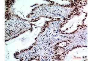 Immunohistochemistry (IHC) analysis of paraffin-embedded Human Lungcancer, antibody was diluted at 1:200. (TP53INP2 antibody)