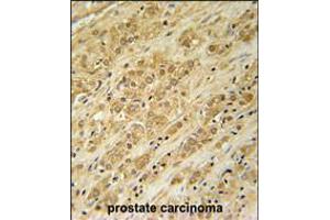 DKC1 Antibody immunohistochemistry analysis in formalin fixed and paraffin embedded human prostate carcinoma followed by peroxidase conjugation of the secondary antibody and DAB staining.