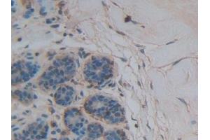 Detection of THBS1 in Human Breast cancer Tissue using Polyclonal Antibody to Thrombospondin 1 (THBS1) (Thrombospondin 1 antibody  (AA 24-221))