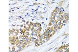 Immunohistochemistry of paraffin-embedded Human colon carcinoma using PEX14 Polyclonal Antibody at dilution of 1:100 (40x lens). (PEX14 antibody)