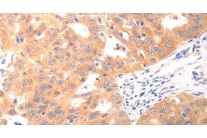 Immunohistochemistry of paraffin-embedded Human ovarian cancer using CAPNS1 Polyclonal Antibody at dilution of 1:60 (Calpain S1 antibody)