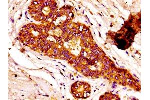 IHC image of ABIN7152610 diluted at 1:100 and staining in paraffin-embedded human breast cancer performed on a Leica BondTM system. (Fatty Acid Synthase antibody  (AA 2155-2495))
