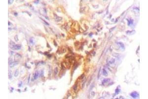 Immunohistochemistry analyzes of IL-2Rβ antibody in paraffin-embedded human lung carcinoma tissue.