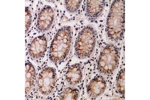 Immunohistochemical analysis of IL-12B staining in human colon cancer formalin fixed paraffin embedded tissue section.