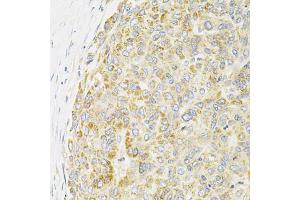 Immunohistochemistry of paraffin-embedded human liver cancer using PPP1CA antibody (ABIN6290760) at dilution of 1:100 (40x lens).