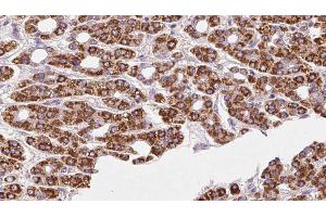 ABIN6272414 at 1/100 staining Human liver cancer tissue by IHC-P. (RHOG antibody  (Internal Region))