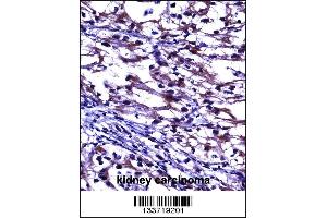 TNFRSF11B Antibody immunohistochemistry analysis in formalin fixed and paraffin embedded human kidney carcinoma followed by peroxidase conjugation of the secondary antibody and DAB staining. (Osteoprotegerin antibody  (AA 243-271))