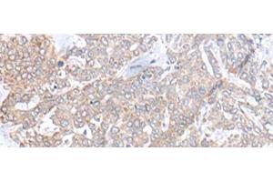Immunohistochemistry of paraffin-embedded Human liver cancer tissue using PLGLB2 Polyclonal Antibody at dilution of 1:65(x200) (PLGLB2 antibody)