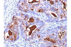 Formalin-fixed, paraffin-embedded human Colon Carcinoma stained with CEA Mouse Monoclonal Antibody (C66/1260). (CEACAM5 antibody)