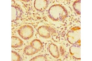 Immunohistochemistry of paraffin-embedded human gastric cancer using ABIN7173760 at dilution of 1:100 (TDRD1 antibody  (AA 12-314))