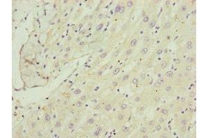 Immunohistochemistry of paraffin-embedded human liver cancer using ABIN7148370 at dilution of 1:100 (C8B antibody  (AA 55-350))