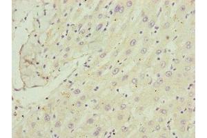 Immunohistochemistry of paraffin-embedded human liver cancer using ABIN7148370 at dilution of 1:100 (C8B antibody  (AA 55-350))