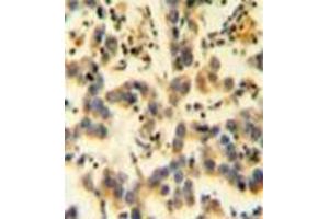 Immunohistochemistry analysis in formalin fixed and paraffin embedded human testis carcinoma reacted with KIAA0090 Antibody (C-term) followed which was peroxidase conjugated to the secondary antibody and followed by DAB staining. (KIAA0090 antibody  (C-Term))