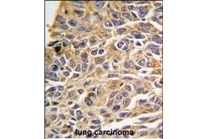 Formalin-fixed and paraffin-embedded human lung carcinoma tissue reacted with RIP3 (RIPK3) antibody (N-term) (ABIN391272 and ABIN2841322) , which was peroxidase-conjugated to the secondary antibody, followed by DAB staining. (RIPK3 antibody  (N-Term))