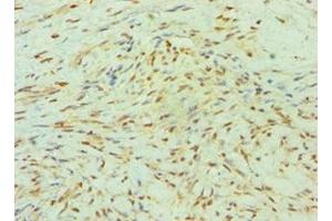 Immunohistochemistry of paraffin-embedded human breast cancer using ABIN7155524 at dilution of 1:100 (SMYD3 antibody  (AA 199-428))