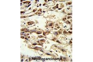 Formalin-fixed and paraffin-embedded human hepatocarcinoma reacted with AIFM2 Antibody (C-term), which was peroxidase-conjugated to the secondary antibody, followed by DAB staining. (AIFM2 antibody  (C-Term))