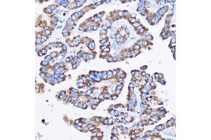 Immunohistochemistry of paraffin-embedded Human thyroid cancer using IL23R Rabbit pAb (ABIN3022245, ABIN3022246, ABIN3022247, ABIN1513088 and ABIN6218691) at dilution of 1:100 (40x lens). (IL23R antibody  (AA 405-629))