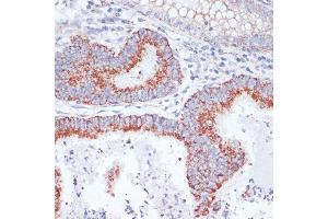 Immunohistochemistry of paraffin-embedded human colon carcinoma using CD71/Transferrin Receptor antibody (ABIN6131555, ABIN6149065, ABIN6149066 and ABIN6221572) at dilution of 1:100 (40x lens). (Transferrin Receptor antibody  (AA 1-140))