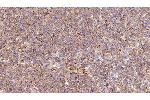 ABIN6273194 at 1/100 staining Human lymph cancer tissue by IHC-P.