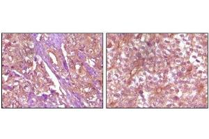 Immunohistochemical analysis of paraffin-embedded Human pancreas carcinoma (left) and breast carcinoma (right) tissue, showing membrane and cytoplasmic (pancreas carcinoma) localization, membrane (breast carcinoma) localization using EphB4 mouse mAb with DAB staining. (EPH Receptor B4 antibody)