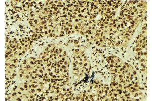 ABIN6268656 at 1/100 staining Human breast cancer tissue by IHC-P. (XBP1 antibody  (C-Term))