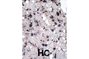Formalin-fixed and paraffin-embedded human hepatocellular carcinoma tissue reacted with HK2 polyclonal antibody  , which was peroxidase-conjugated to the secondary antibody, followed by DAB staining. (Hexokinase 2 antibody  (Internal Region))