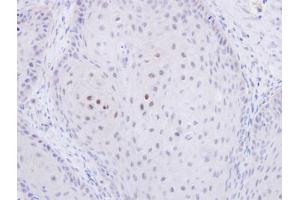 IHC-P Image Immunohistochemical analysis of paraffin-embedded Cal27 xenograft, using C20orf11, antibody at 1:500 dilution.