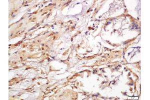 Formalin-fixed and paraffin embedded human colon cancer labeled with Anti-phospho-CDKN1A (Ser130) Polyclonal Antibody, Unconjugated (ABIN757417) at 1:200 followed by conjugation to the secondary antibody and DAB staining (p21 antibody  (pSer130))