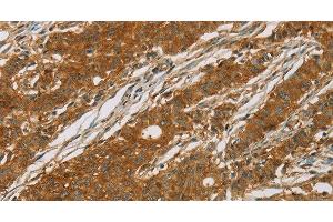 Immunohistochemistry of paraffin-embedded Human gasrtic cancer tissue using CYP27A1 Polyclonal Antibody at dilution 1:50 (CYP27A1 antibody)