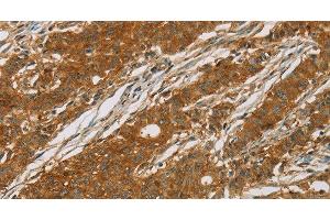 Immunohistochemistry of paraffin-embedded Human gasrtic cancer tissue using CYP27A1 Polyclonal Antibody at dilution 1:50 (CYP27A1 antibody)