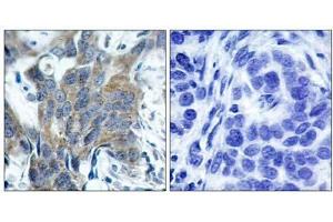 Immunohistochemical analysis of paraffin-embedded human breast carcinoma tissue, using β-Catenin (phospho-Ser33) antibody (E011218). (beta Catenin antibody  (pSer33))