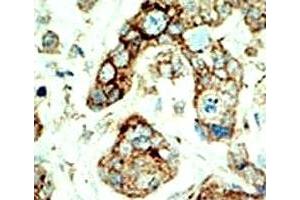 IHC analysis of FFPE human breast carcinoma tissue stained with the EphA2 antibody (EPH Receptor A2 antibody  (AA 30-60))