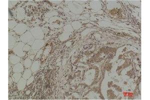 Immunohistochemistry (IHC) analysis of paraffin-embedded Human Breast Carcinoma using Pan Methylated Lysine Monoclonal Antibody. (Methylated Lysine (pan) antibody)