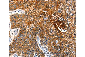 Immunohistochemistry of Human esophagus cancer using AQP5 Polyclonal Antibody at dilution of 1:40