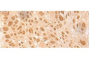 Immunohistochemistry of paraffin-embedded Human esophagus cancer tissue using DBP Polyclonal Antibody at dilution of 1:25(x200) (DBP antibody)