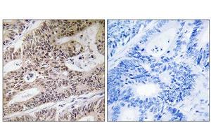 Immunohistochemistry analysis of paraffin-embedded human colon carcinoma tissue using NPHP4 antibody.