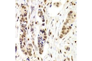 Immunohistochemistry of paraffin-embedded human breast cancer using NASP Antibody.
