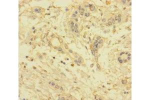 Immunohistochemistry of paraffin-embedded human pancreatic cancer using ABIN7175533 at dilution of 1:100 (VKORC1L1 antibody  (AA 38-91))