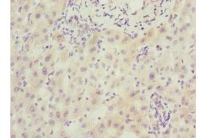 Immunohistochemistry of paraffin-embedded human liver cancer using ABIN7168604 at dilution of 1:100 (SCAND1 antibody  (AA 1-179))